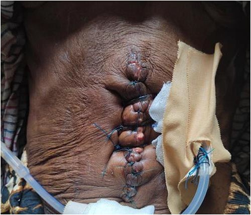 Postoperative image after the secondary tension suture.