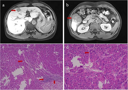 Contrast-enhanced magnetic resonance imaging at admission (upper row) and histopathology of primary tumors (lower row) of (a) the tumor at the junction of the left inner and upper right anterior lobes, and (b) the tumor in the lower right posterior lobe. Histopathology of the tumor in panels c and d showed tumor cells in Edmondson Grade II (leftward arrow), infiltration by macrophagocytes and lymphocytes (rightward arrow), and hepatocyte steatosis (downward arrows). Magnification, 40× in panel c or 100× in panel d.