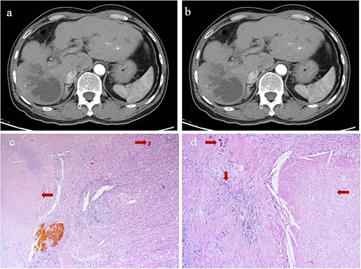 Intrahepatic recurrence and response to TACE. (a, b) Contrast-enhanced computed tomography in the (a) arterial phase or (b) venous phase after two cycles of TACE, showing PR of the recurrent tumor liver. (c, d) Histopathology of recurrent tumor after TACE at magnifications of (c) 40× or (d) 100×, showing necrosis of more than 90% of the tumor, proliferative fibrous tissue (leftward arrows), blue embolic agent in vasculature (rightward arrows), multinucleated giant cells, and abundant infiltration by lymphocytes (downward arrow).