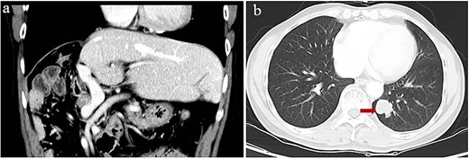 Computed tomography of lung metastasis after 2 years of adjuvant ICI. (a) Imaging at the venous stage did not reveal obvious lesions in the residual liver. (b) Imaging of the left lower lung revealed a single tumor (arrow).