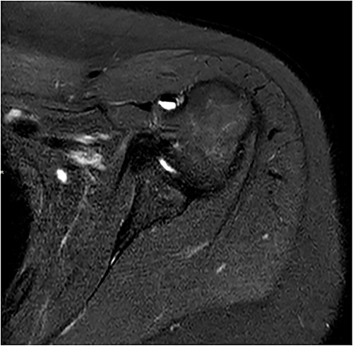 Coronal and axial T2 fat saturated image of left shoulder showing thickened inferior capsule of low T2 signal, characteristic of freezing phase in adhesive capsulitis.