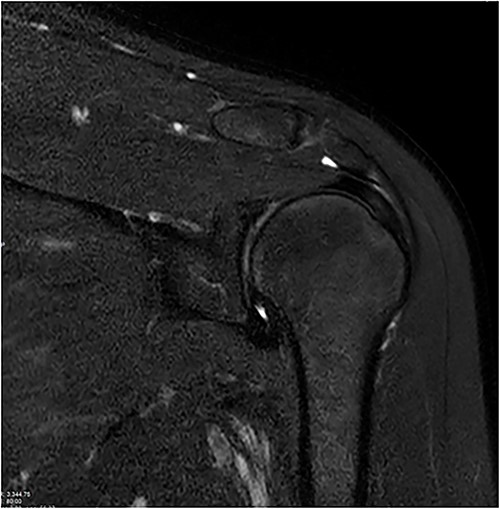 Coronal and axial T2 fat saturated image of left shoulder showing thickened inferior capsule of low T2 signal, characteristic of freezing phase in adhesive capsulitis.