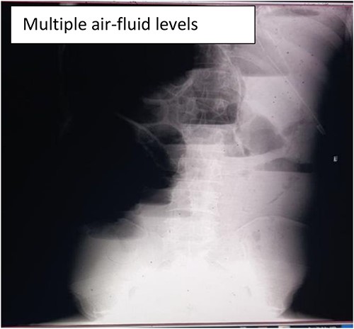 Abdominal X-ray showing dilated small with significant multiple air-fluid levels.