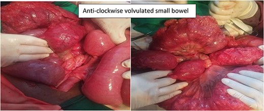 Intra-operative finding shows anticlockwise volvulated small bowel.