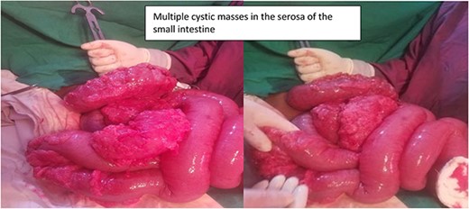 Intra-operative finding shows multiple air-filled cysts in the small bowel.