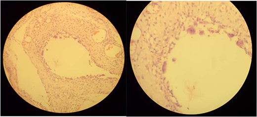 Microscopic examination shows variable-sized cystic spaces lined by thin fibrous stroma with focal multinucleated macrophages surrounding the space and intervening fibrous stroma with congested blood vessels and neutrophil mixed inflammatory cells.