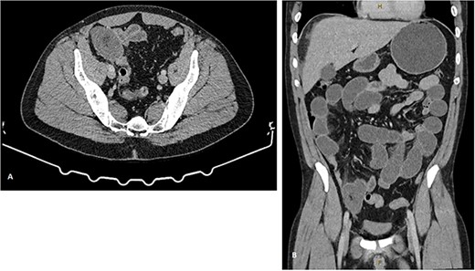 CT images demonstrating small bowel obstruction with TP in the right iliac fossa. (A) representative axial imaging slice, and (B) representative coronal slice.