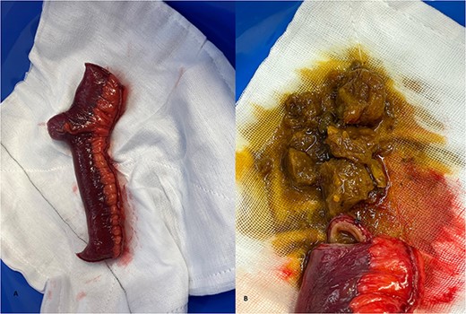 Gross examination of the resected small bowel and content demonstrating the (A) Meckel’s diverticulum and (B) obstructing fibrous phytobezoar.