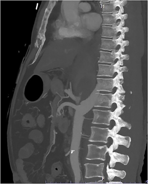 Sagittal CT slice demonstrating coeliac avulsion.
