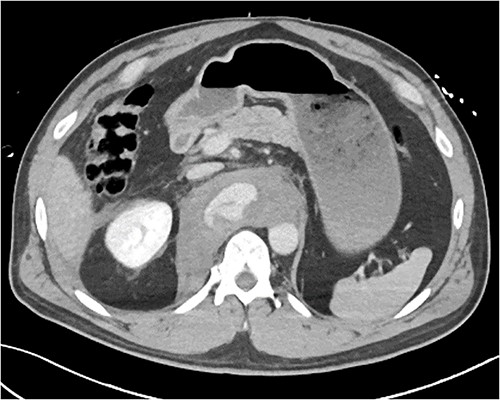 Axial CT slice demonstrating coeliac trunk avulsion with active bleeding into a large retroperitoneal haematoma.