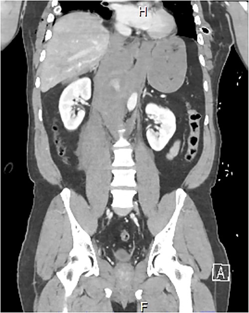 Coronal CT slice demonstrating coeliac trunk avulsion with active bleeding into a large retroperitoneal haematoma.