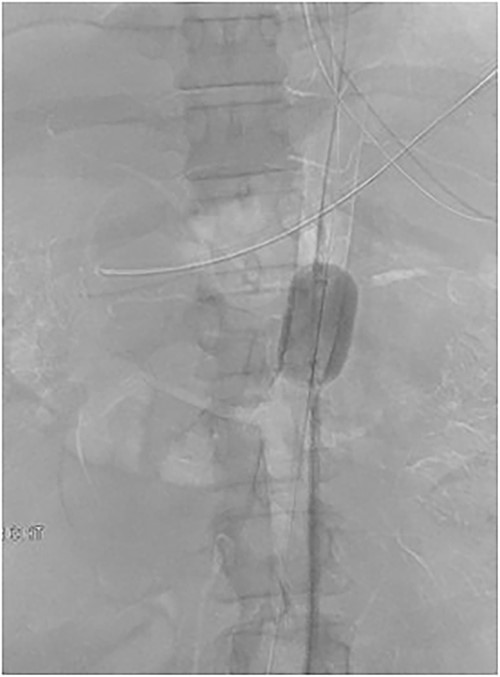 Fluoroscopic image demonstrating endovascular balloon occlusion of aorta at the level of CA avulsion, superior to SMA and Bilateral Renal artery origins.