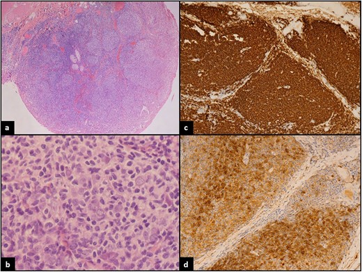 (a) Low power: conjunctival mucosa with underlying neoplastic lymphoid proliferation showing nodular architecture. (b) High power: atypical small to medium in size lymphocytes with cleaved nuclei. (c) CD20 strongly positive by most of the lymphoma cells confirming B lineage. (d) CD10 positive in the lymphoma cells.