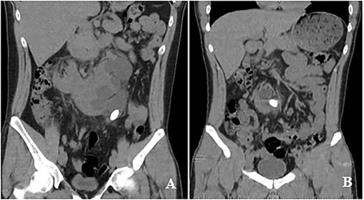 CT images: CT showed moved stone in the left renal pelvis.