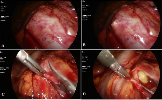 During operation: A and B: marking the location of the stone; C: opening of the renal pelvis with laparoscopic scissors; D: the process of removing stone.