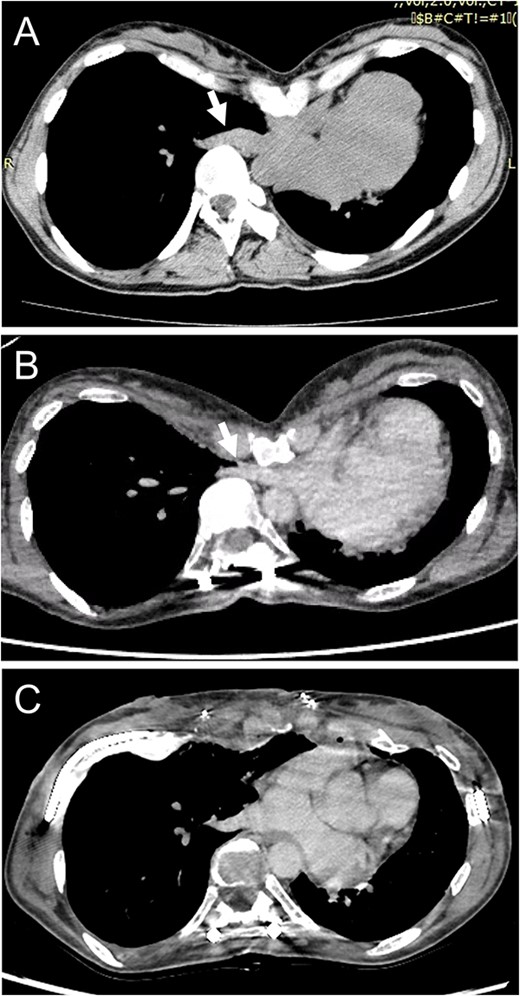 (A) Chest CT shows no compression of the right inferior pulmonary vein (IPV) before scoliosis repair (arrow). (B) Severe right IPV stenosis is induced by posterior spinal fusion (arrow). (C) Postoperative chest CT indicates that right IPV stenosis is released by elevation of the depressed sternum.