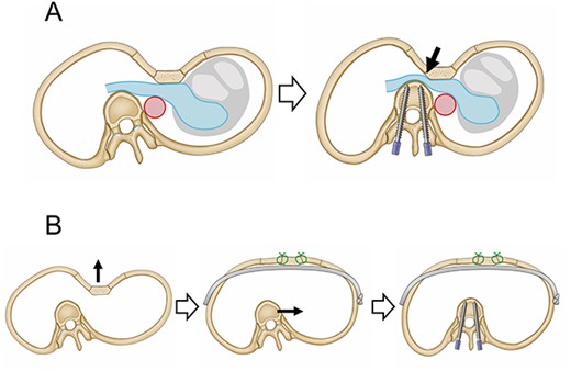 Schematic images of treatment for PE and scoliosis. (A) The right inferior pulmonary vein is sandwiched between the depressed sternum and the thoracic vertebrae, which moved toward the midline due to scoliosis surgery (arrow). (B) PE repair following scoliosis repair makes it possible to secure the distance between the sternum and thoracic vertebrae.