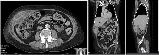 CT abdomen with portal venous contrast showing gallbladder collection extending to lateral abdominal wall.