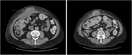 CT abdomen with portal venous contrast in axial plane showing extension of collection towards the paraumbilical region.