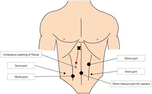 Location of laparoscopic ports to allow optimal dissection of gallbladder and fistula tract. The arrow shows the course of the fistula tract which originates from the gallbladder (X) just to the right of the falciform ligament and extends towards the cutaneous opening (x).