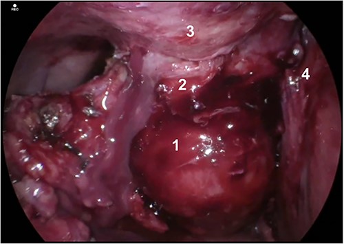 Gallbladder and fistula communicating with abdominal wall. Structures depicted: 1. Gallbladder, 2. Fistula, 3. Abdominal Wall, 4. Liver.