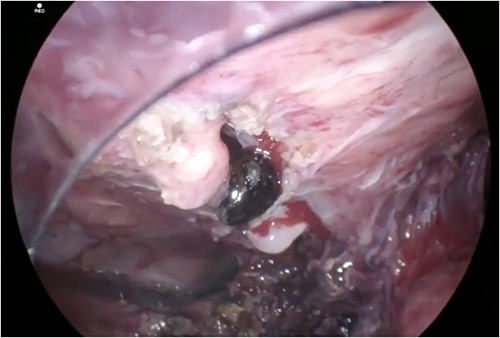 Internal opening of fistula tract after dissection of the gallbladder fundus away from the anterior abdominal wall. A gallstone is shown lodged in the fistula tract with further gallstones embedded more superficially.