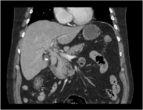 CT scan showing thickening and enhancement of the entire extrahepatic common bile duct with intrahepatic duct dilatation.