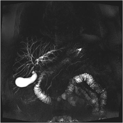 MRCP showing involvement of entire common bile duct.