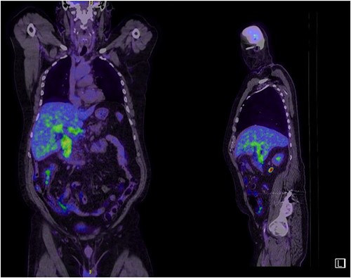 Abnormal FDG uptake on PET scan extending from intrahepatic duct to distal common bile duct with uptake in the tail of pancreas.