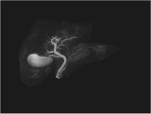 Follow-up MRCP with resolution of common bile duct pathology.