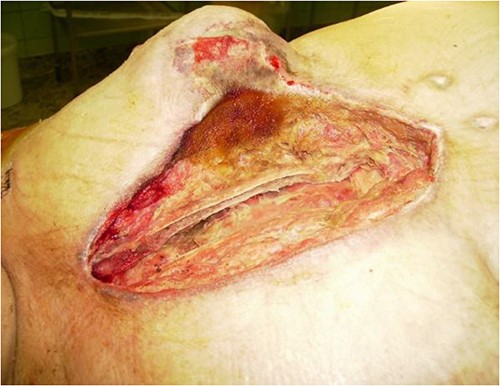 Operative view after debridement and NPWT.