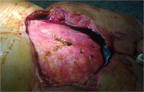 Extensive suprasternal dehiscence after sternal closure and NPWT.