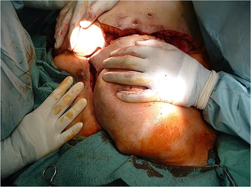 By sliding the advancement flaps towards the midline and cranially, approximately the upper two-thirds of the dehiscence were closed without any tension.