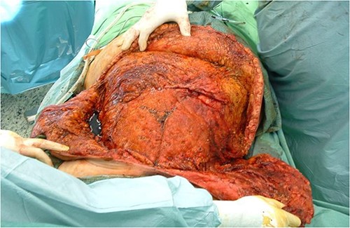 With the four advancement flaps, the huge dehiscence was fully covered with minimal tension.