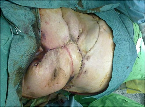 With this expanded tissue mobilization, we were able to cover the defect.