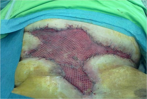 Two months after the second plastic surgery intervention, we had to cover the central dehiscence by applying a half-thickness skin autograft.