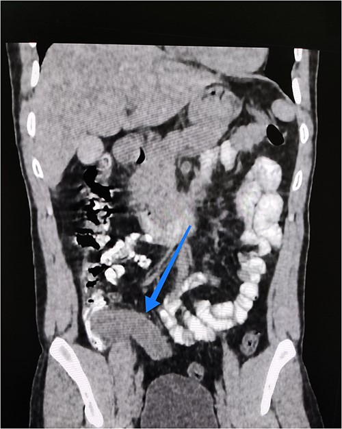 Coronal view of abdominal contrast CT showing the oblong structure originating from the medial side of the caecum and extending down to the pelvis.