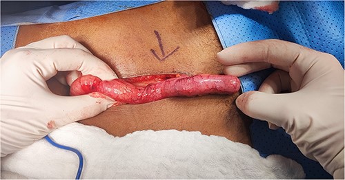 Intraoperative view of the mucocele.