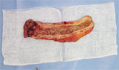 Appendiceal specimen showing fish egg shape of myxoglobulosis.