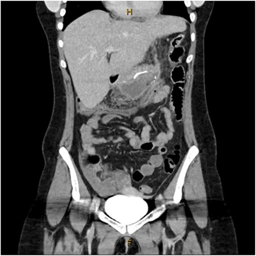 Coronal CT image showing staple line collection at time of presentation. The image shows a 14 × 7 × 5 cm3 collection adjacent to the sleeve gastrectomy staple line.