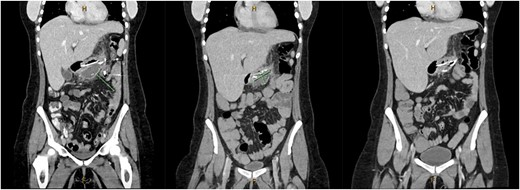 Coronal CT images on Days 2, 9 and 14 post insertion of nasobiliary drainage tube to sleeve gastrectomy staple line collection showing interval reduction in collection size.