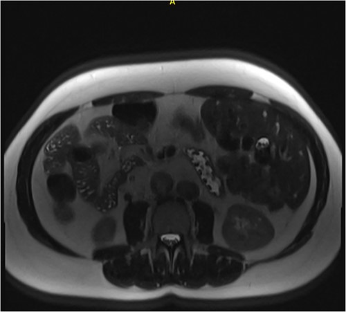 Axial MRCP scan demonstrating small stones in a contracted gallbladder.