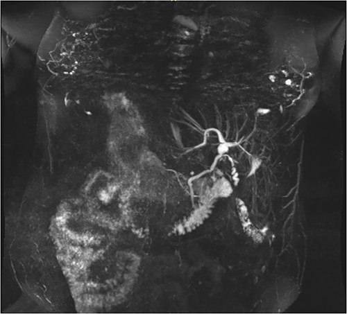 Coronal MRCP scan demonstrating a 10 mm area of saccular duct dilatation at the hilar confluence. Large, dilated vessels/varices surrounding the gallbladder fossa can also be appreciated.