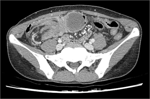 Initial CT scan of the colo-colic intussusception and the septated cystic tumor.