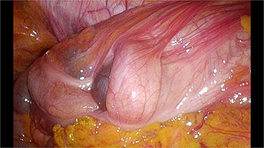 Laparoscopic view of the colo-colic intussusception.