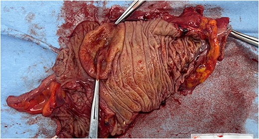 The cystic tumor on the fresh specimen.