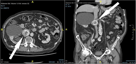 CT scan findings, 4.5 × 4 × 4 cm right retroperitoneal mass posterior to the inferior vena cava, with compression on the inferior vena cava and the right renal artery (arrow).