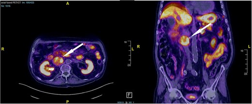 DOTATE-PET/CT: sizeable retrocaval mass with edge-accentuated radionuclide storage, compatible with a paraganglioma or a lymph node metastasis of a neuroendocrine tumor (arrow).