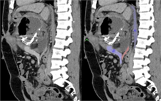 Sagittal section of pre-operative CT with portal venous contrast showing the lesions relationship to major vascular structures of the abdomen. Labels: ^ - fistula opening, blue # - superior mesenteric vein, blue * - inferior vena cava, red - superior mesenteric artery.
