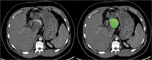 Axial section of CT with arterial contrast showing the hepatic artery (red) traversing within the superior aspect of the lesion (green).
